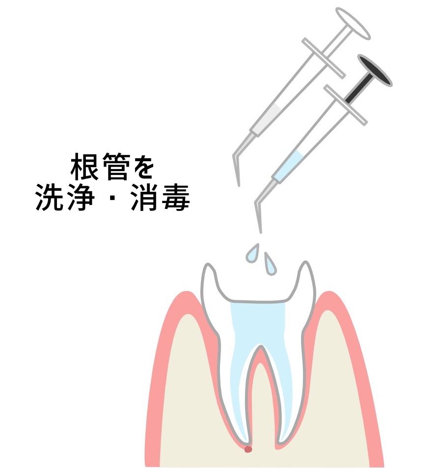 根管の洗浄と消毒